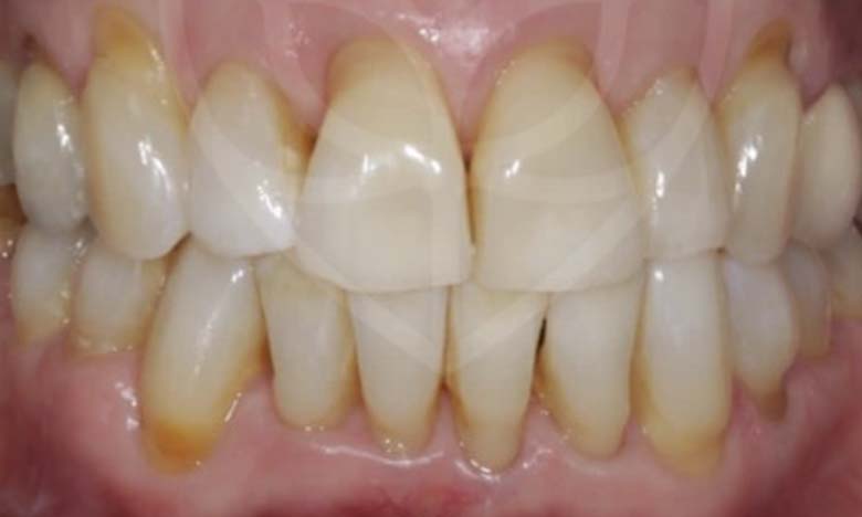 After - Bullsmoor Dental