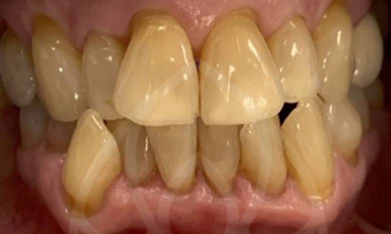 Before - Bullsmoor Dental