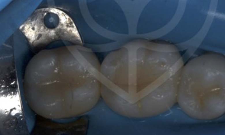 After - Bullsmoor Dental & Aesthetics Clinic