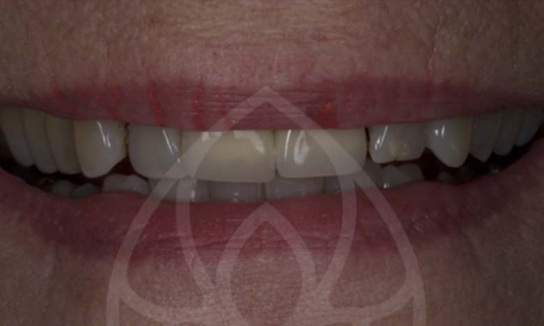 Before - Bullsmoor Dental & Aesthetics Clinic