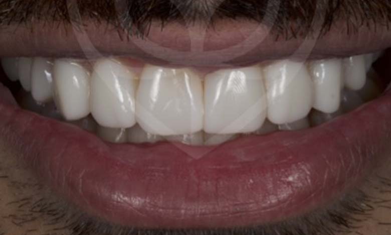 After - Bullsmoor Dental
