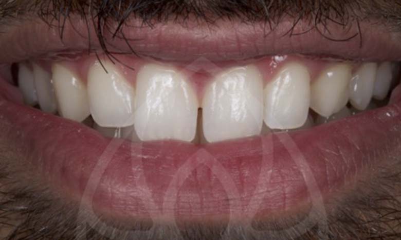 Before - Bullsmoor Dental