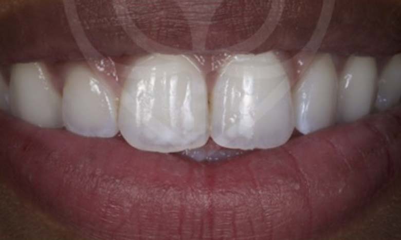 After - Bullsmoor Dental