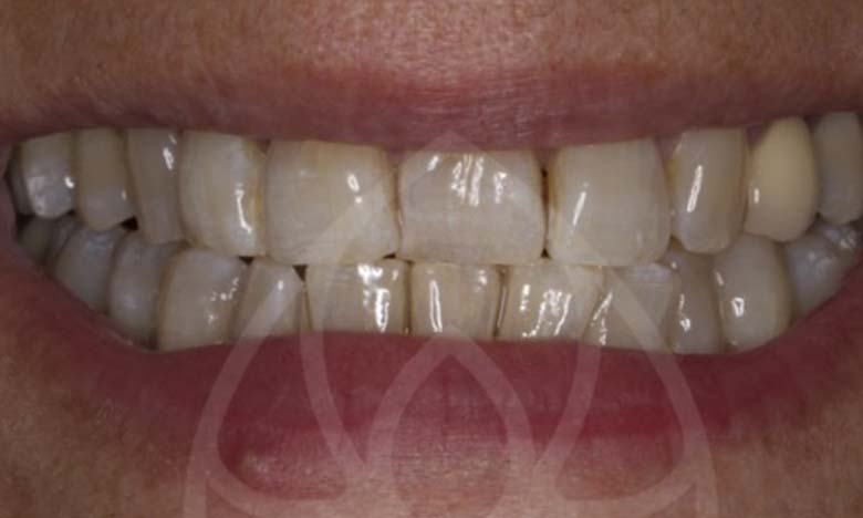 Before - Bullsmoor Dental