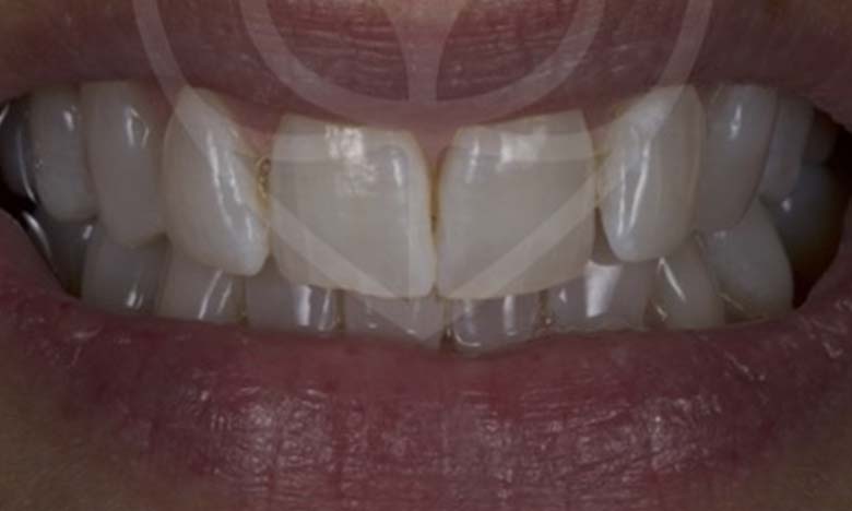 After - Bullsmoor Dental