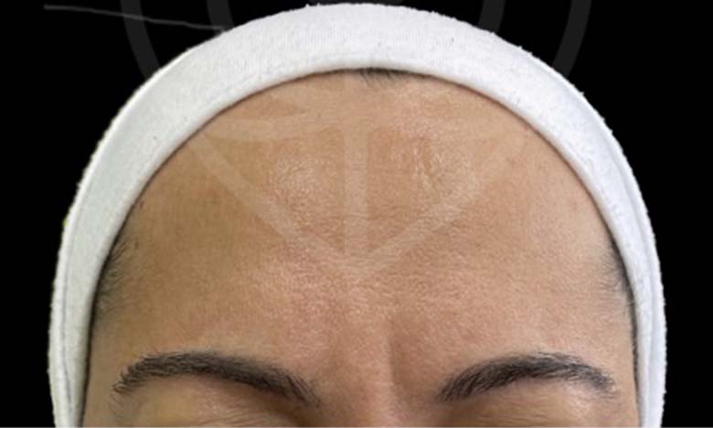 After - Bullsmoor Dental