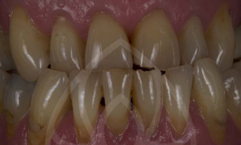 Before - Bullsmoor Dental & Aesthetics Clinic