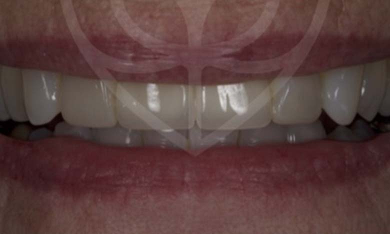 After - Bullsmoor Dental & Aesthetics Clinic
