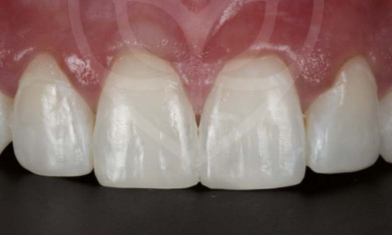 After - Bullsmoor Dental & Aesthetics Clinic