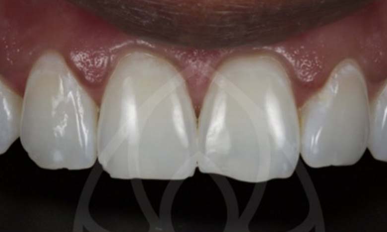 Before - Bullsmoor Dental & Aesthetics Clinic