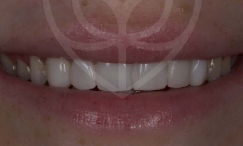 After - Bullsmoor Dental & Aesthetics Clinic