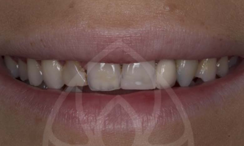 Before - Bullsmoor Dental & Aesthetics Clinic