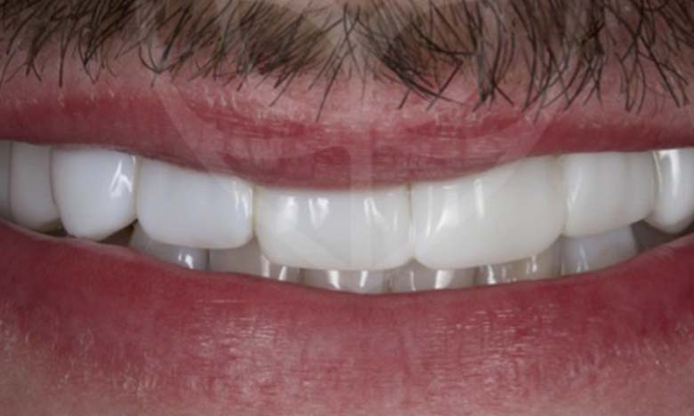 After - Bullsmoor Dental