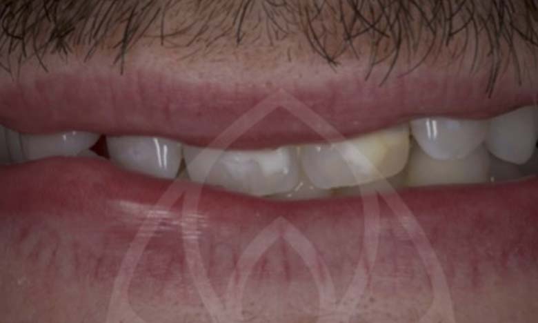 Before - Bullsmoor Dental