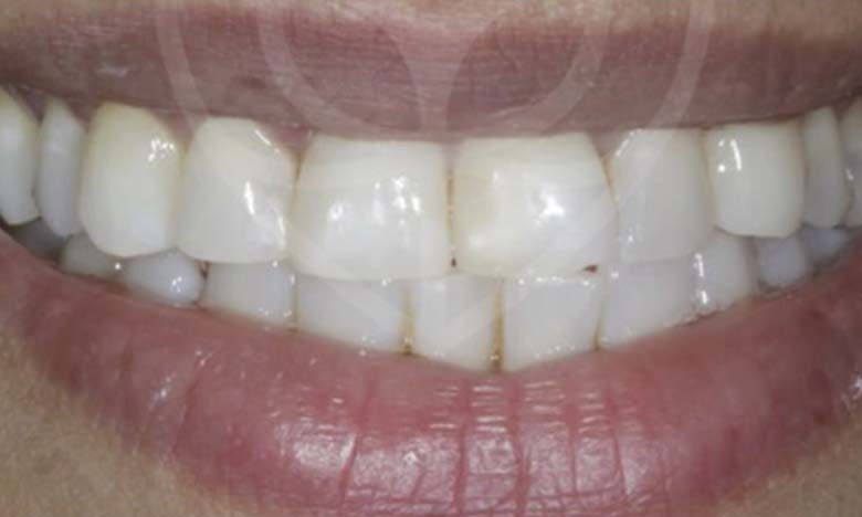 After - Bullsmoor Dental