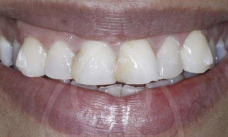 Before - Bullsmoor Dental