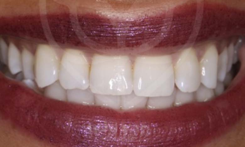 After - Bullsmoor Dental