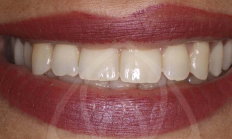 Before - Bullsmoor Dental