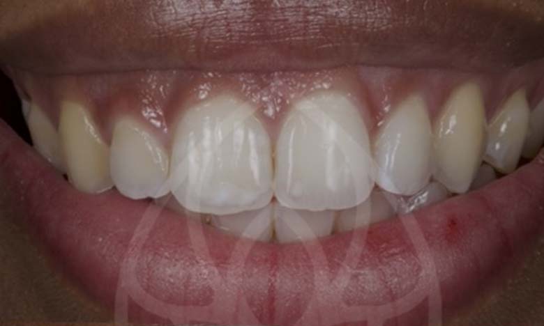 Before - Bullsmoor Dental