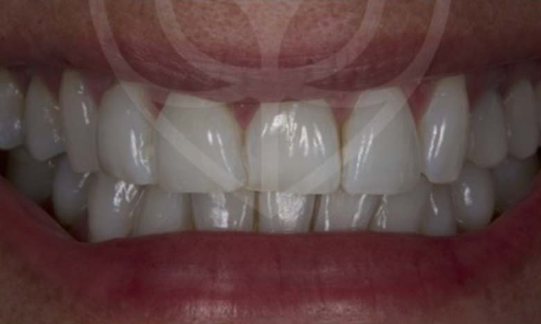 After - Bullsmoor Dental & Aesthetics Clinic