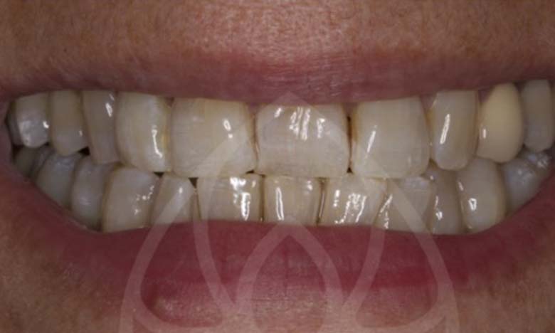 Before - Bullsmoor Dental & Aesthetics Clinic