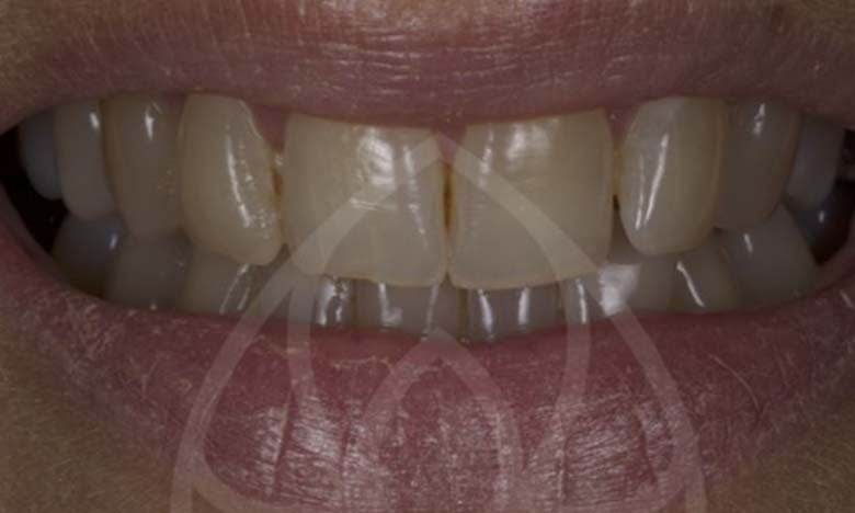 Before - Bullsmoor Dental