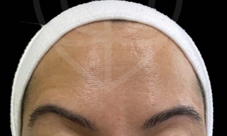 After - Bullsmoor Dental