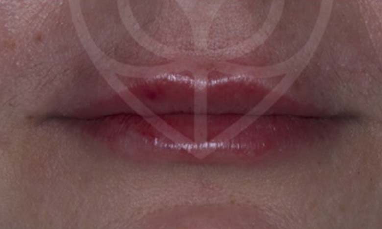 After - Bullsmoor Dental