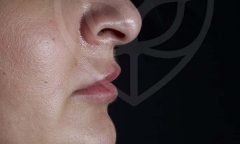 After - Bullsmoor Dental