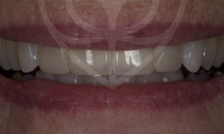 After - Bullsmoor Dental & Aesthetics Clinic