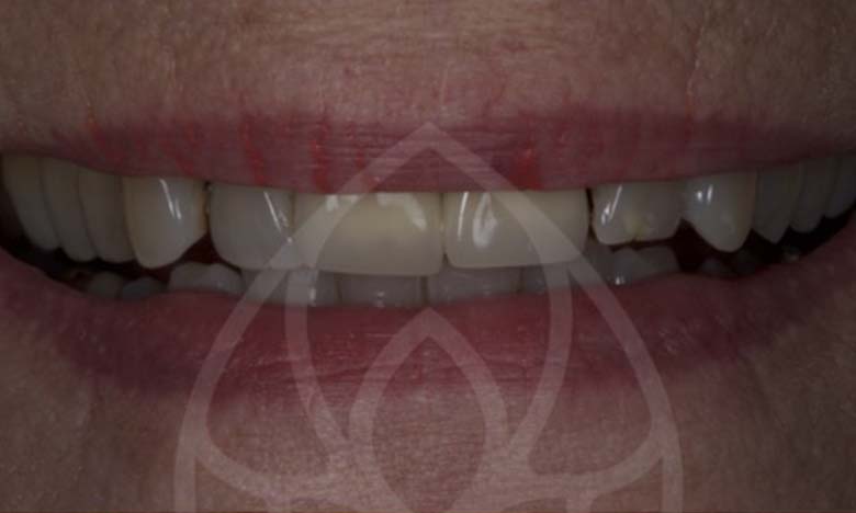 Before - Bullsmoor Dental & Aesthetics Clinic