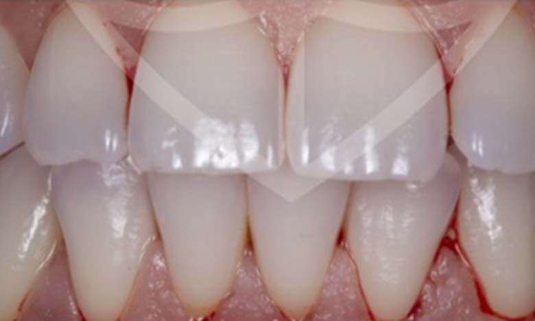 After - Bullsmoor Dental & Aesthetics Clinic