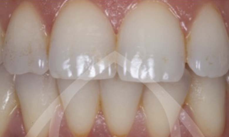 Before - Bullsmoor Dental & Aesthetics Clinic