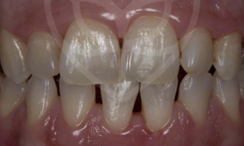 After - Bullsmoor Dental & Aesthetics Clinic