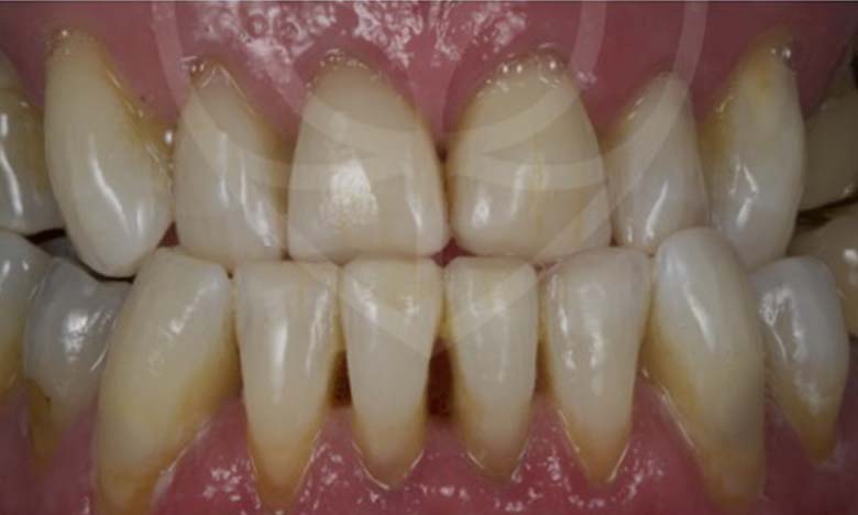 After - Bullsmoor Dental & Aesthetics Clinic