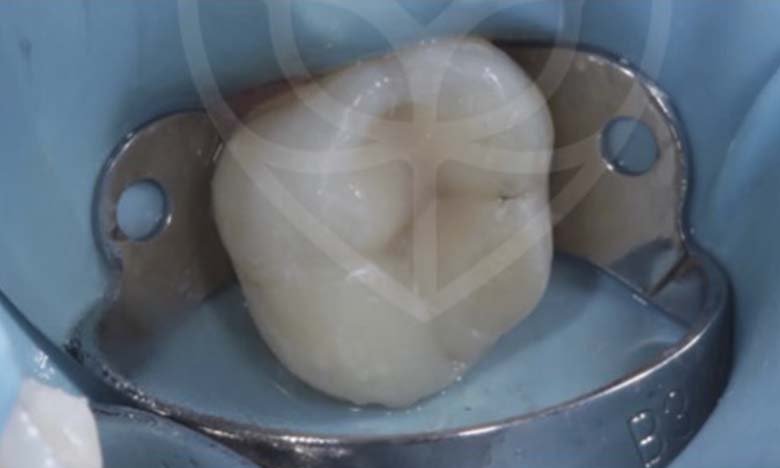 After - Bullsmoor Dental & Aesthetics Clinic