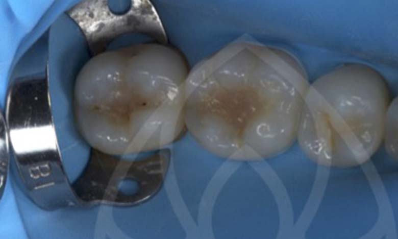 Before - Bullsmoor Dental & Aesthetics Clinic